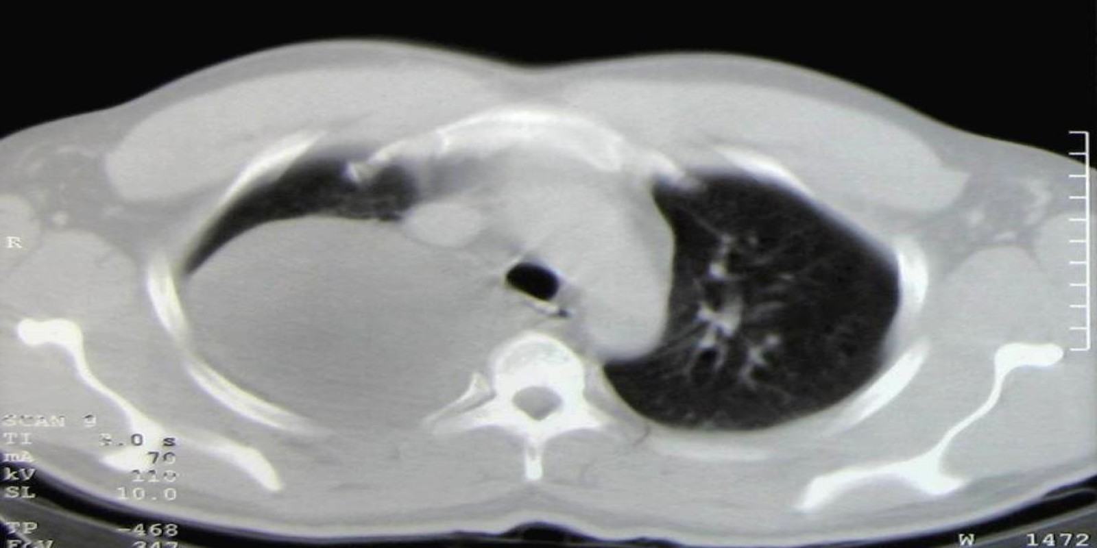 Caso Código 164B de Ganglioneuroma mediastinal 164B