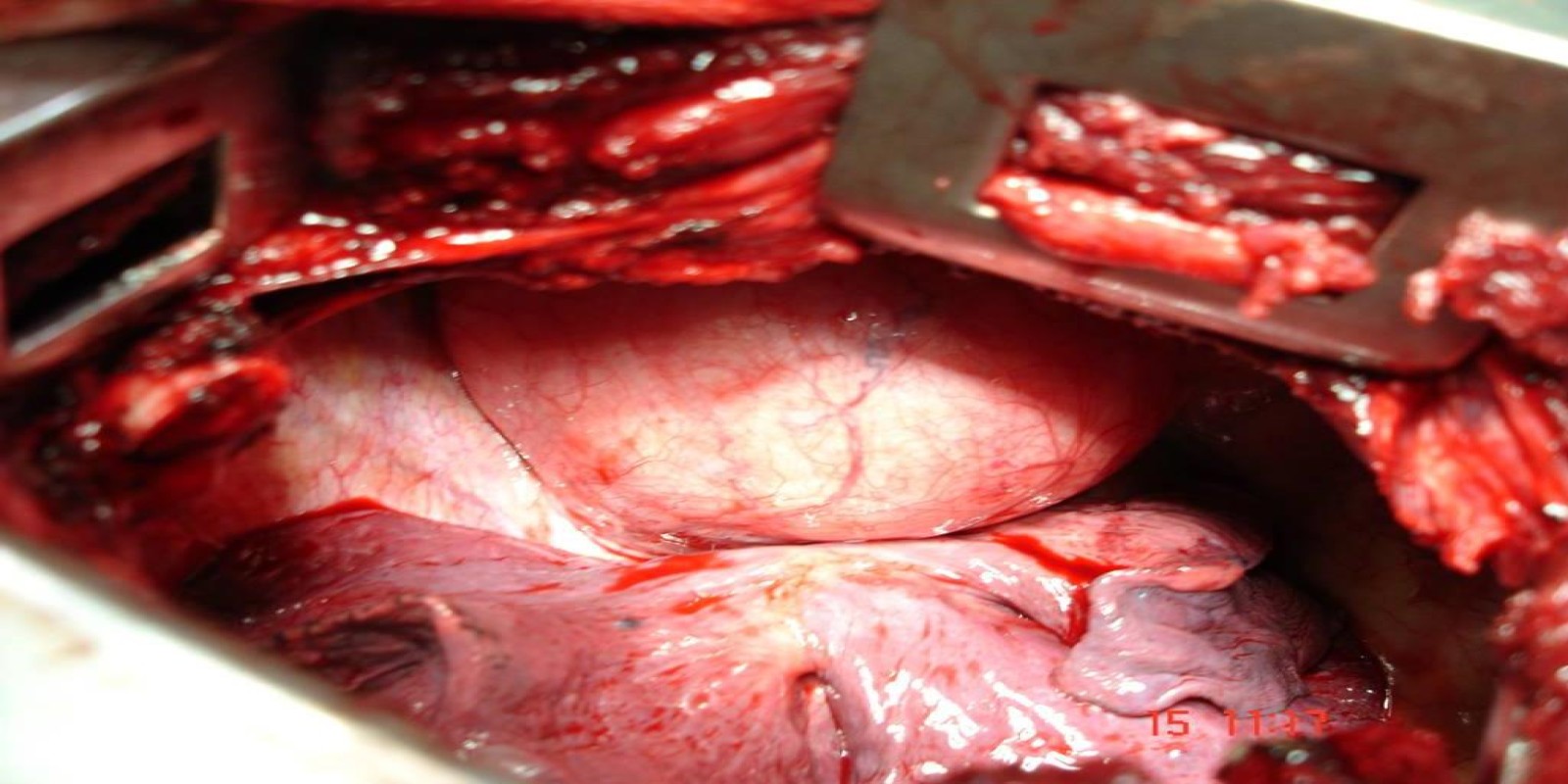 Caso Código 164C de Ganglioneuroma mediastinal 164C