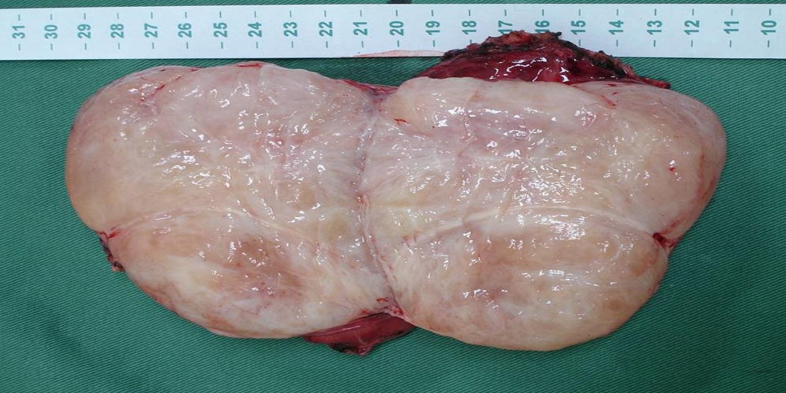 Caso Código 165E de Ganglioneuroma mediastinal 165E