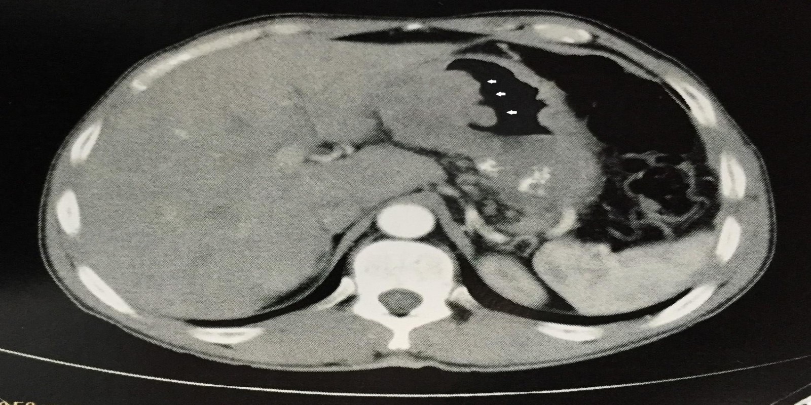 Caso Código 168A de Câncer Gástrico 168A