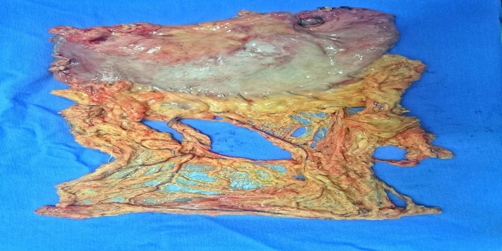 Caso Código 168B de Câncer Gástrico 168B