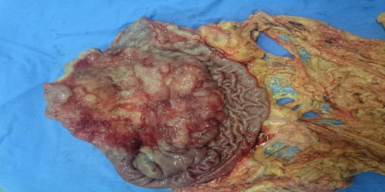 Caso Código 168C de Câncer Gástrico 168C