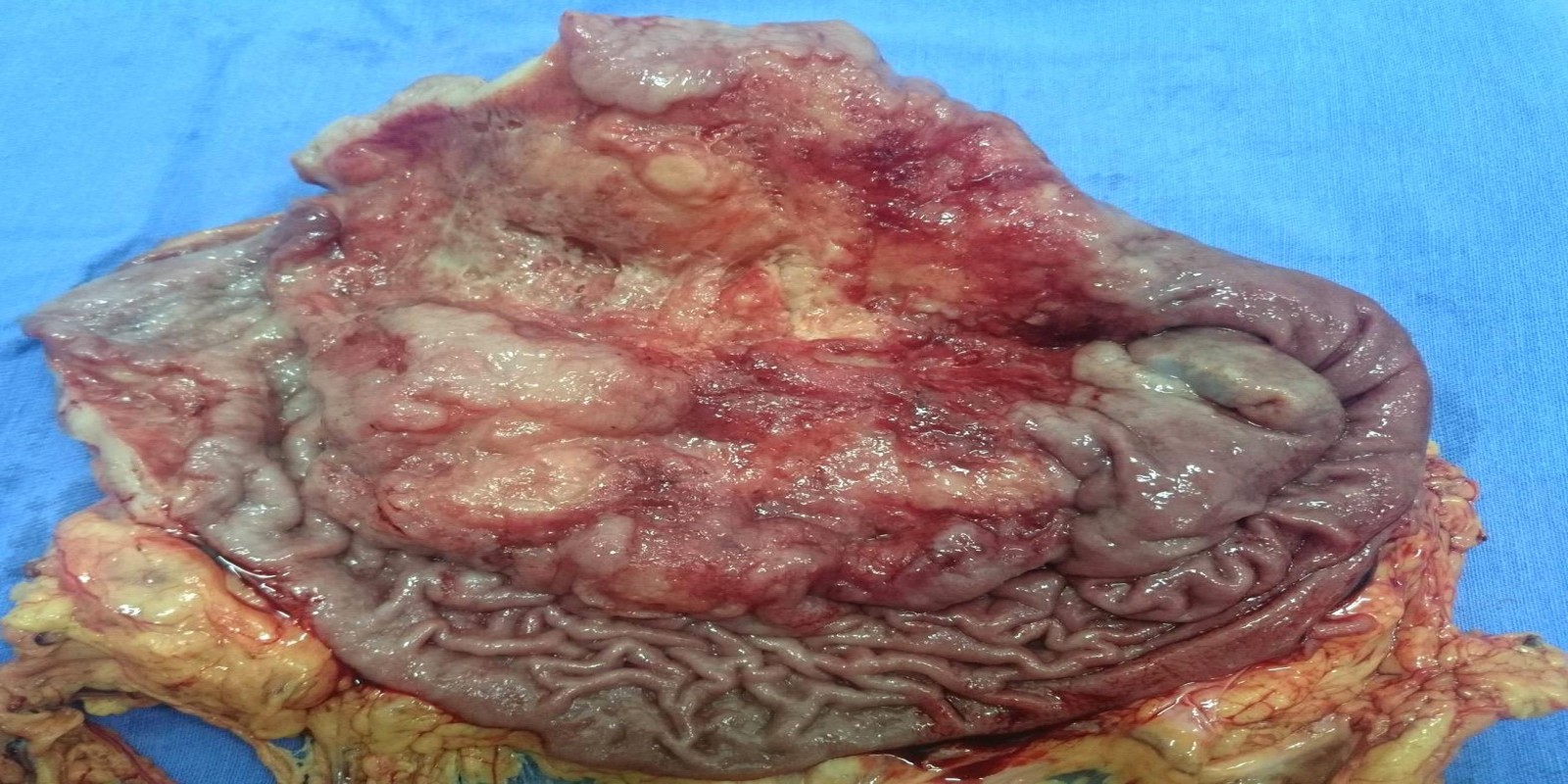 Caso Código 168D de Câncer Gástrico 168D