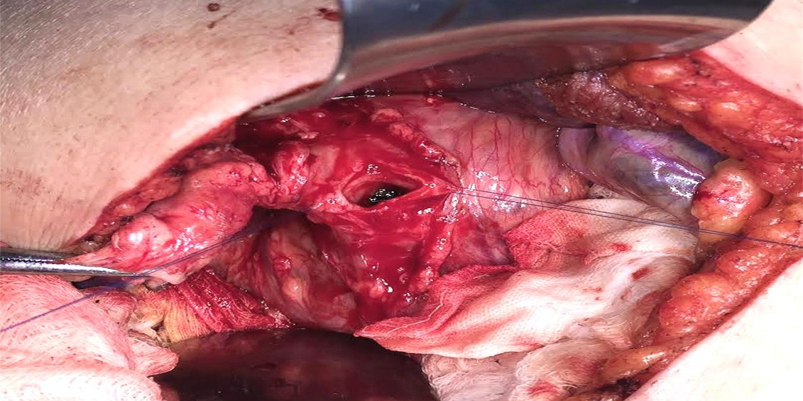 Caso Código 180B de Coledocolitíase 180B