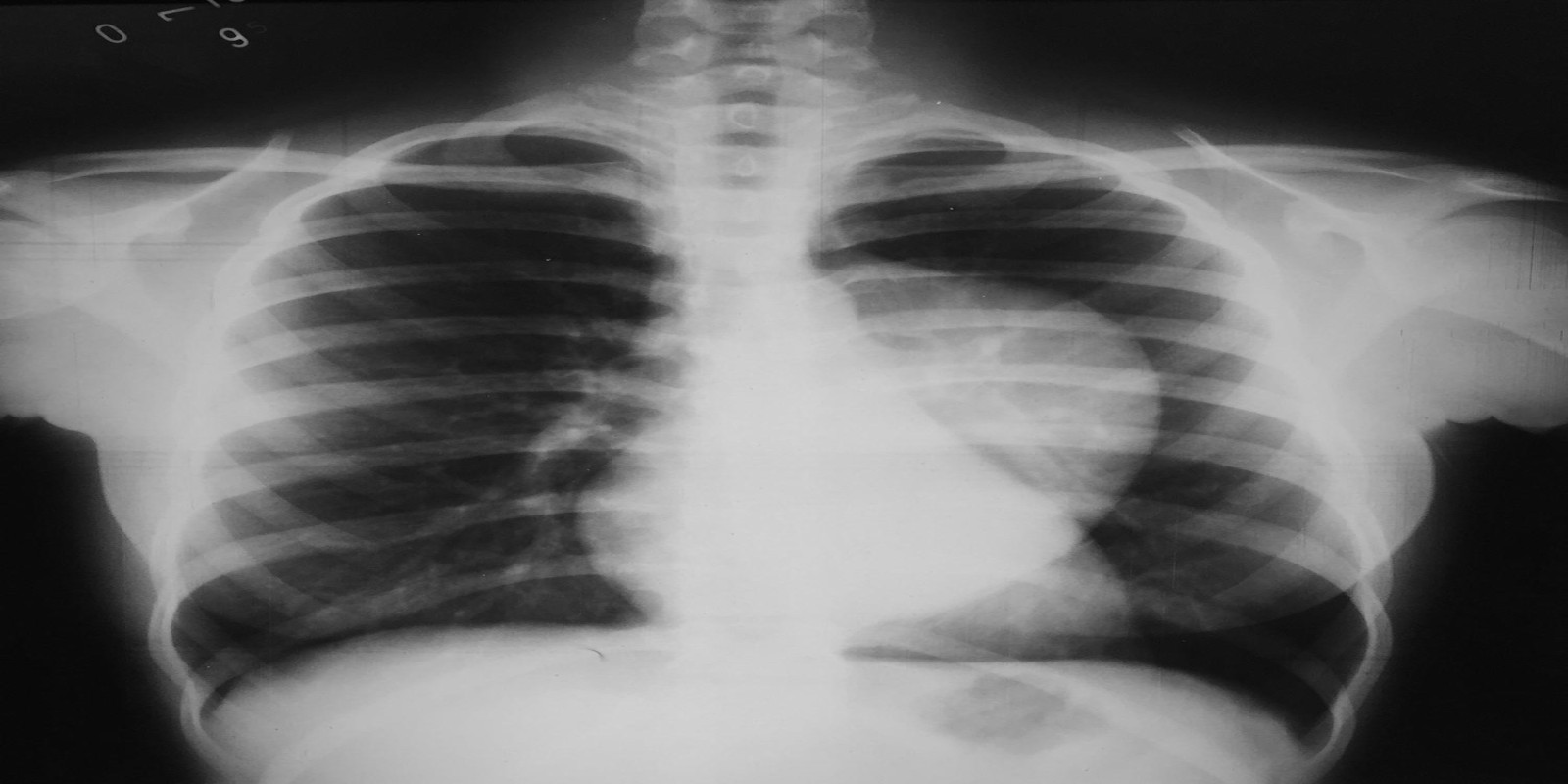 Caso Código 186A de Ganglioneuroma mediastinal 186A