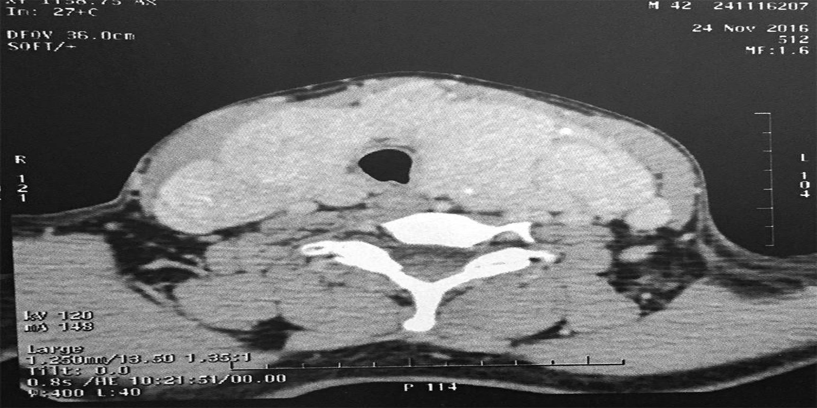 Caso Código 194A de Bócio Multinodular Atóxico 194A