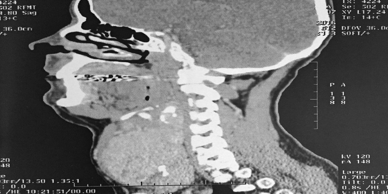 Caso Código 194B de Bócio Multinodular Atóxico 194B