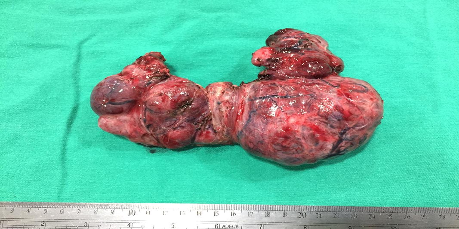 Caso Código 194C de Bócio Multinodular Atóxico 194C