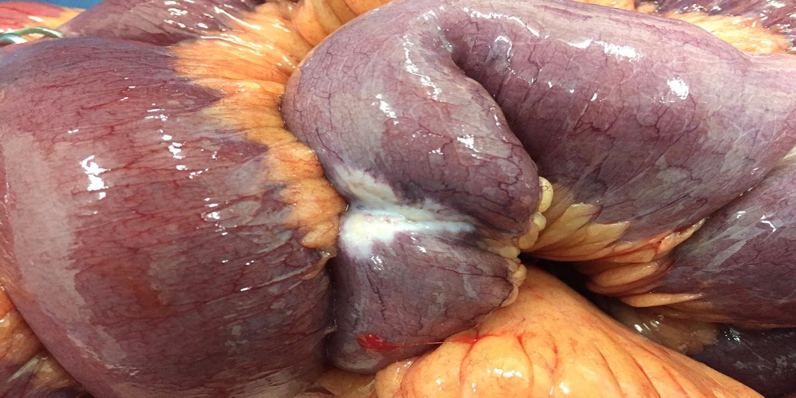 Caso Código 195A de Tumor neuroendócrino - Carcinóide 195A