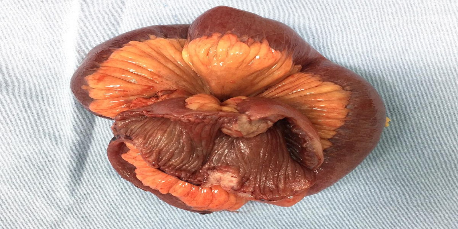 Caso Código 195B de Tumor neuroendócrino - Carcinóide 195B