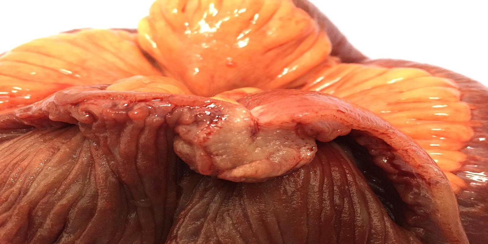 Caso Código 195C de Tumor neuroendócrino - Carcinóide 195C