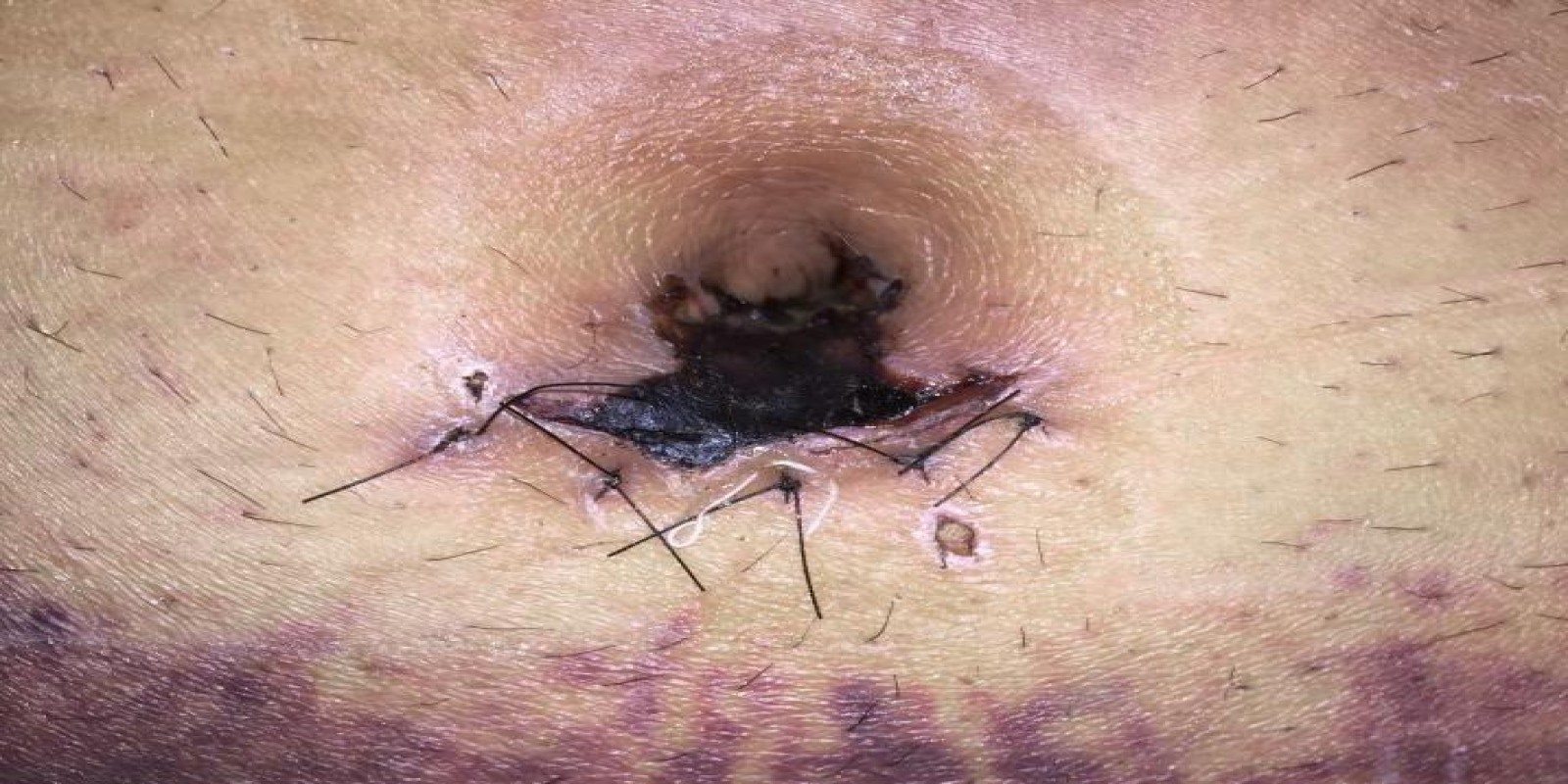 Caso Código 197A de Hérnia Umbilical 197A