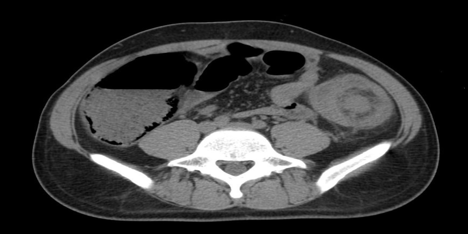 Caso Código 199A de Intussuscepção 199A