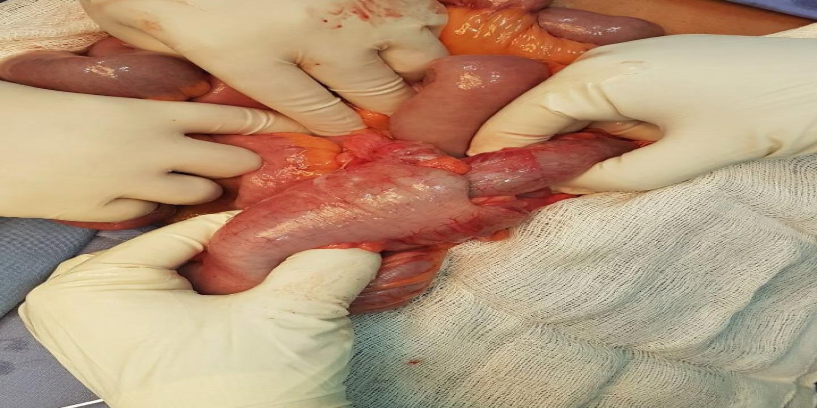 Caso Código 199B de Intussuscepção 199B