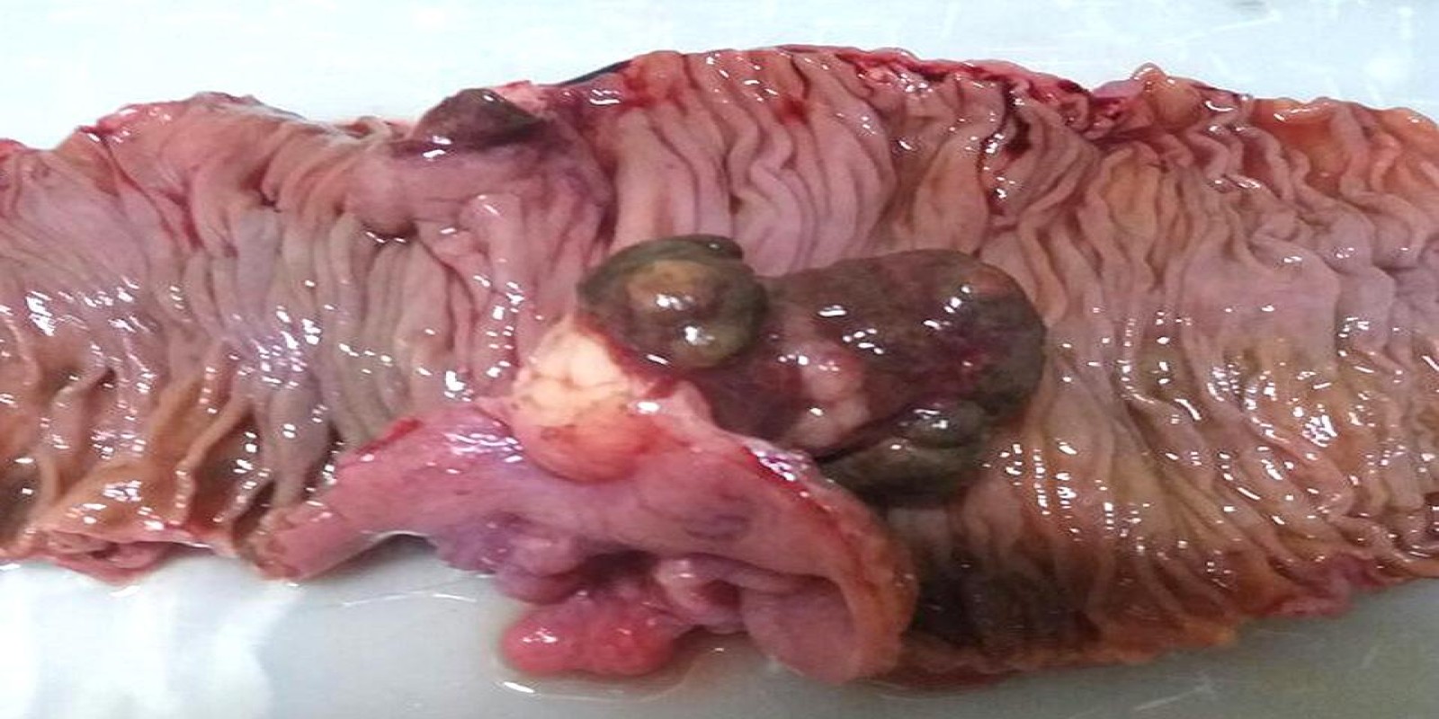 Caso Código 199C de Intussuscepção 199C