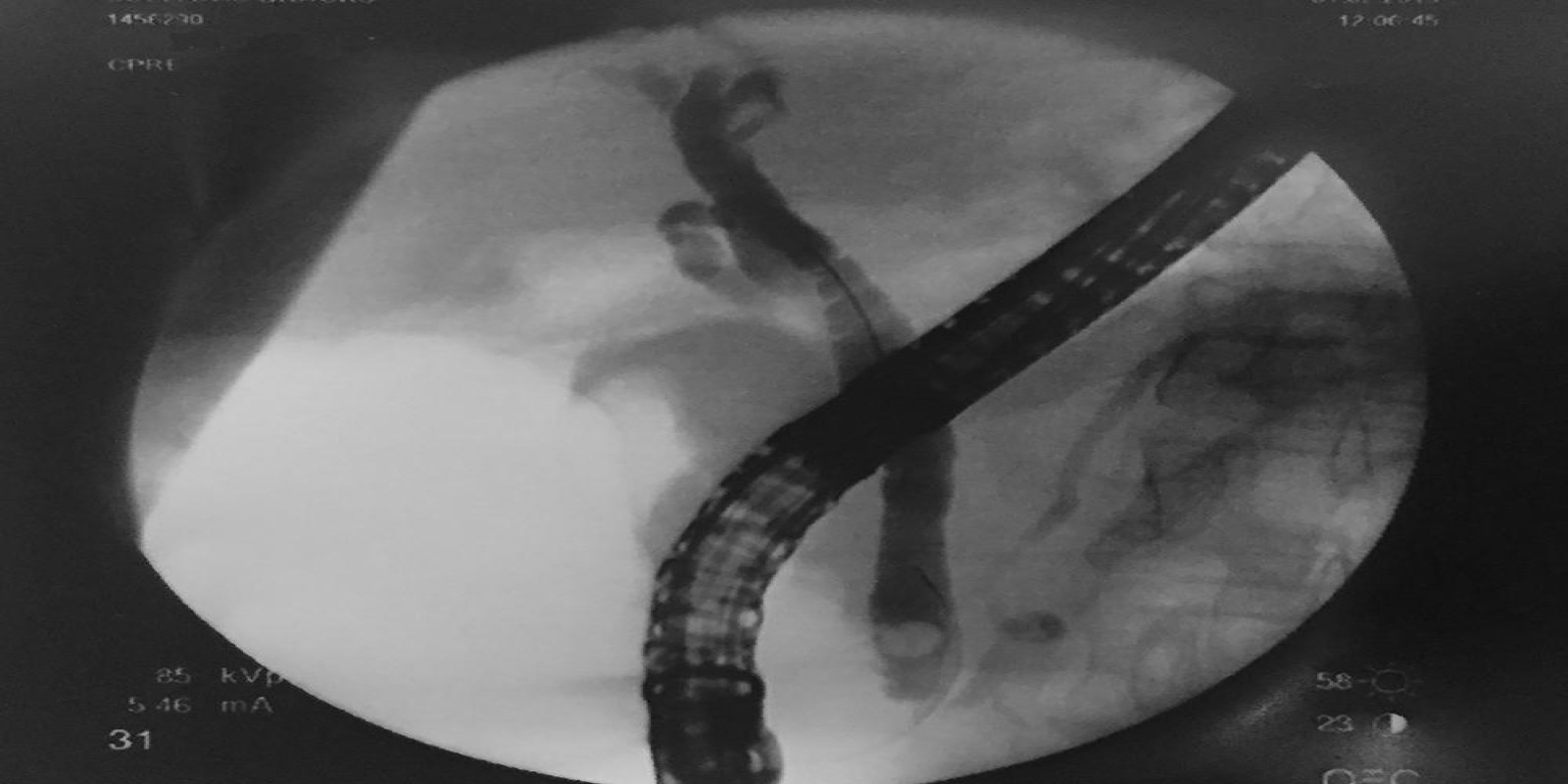 Caso Código 217A de Coledocolitíase 217A