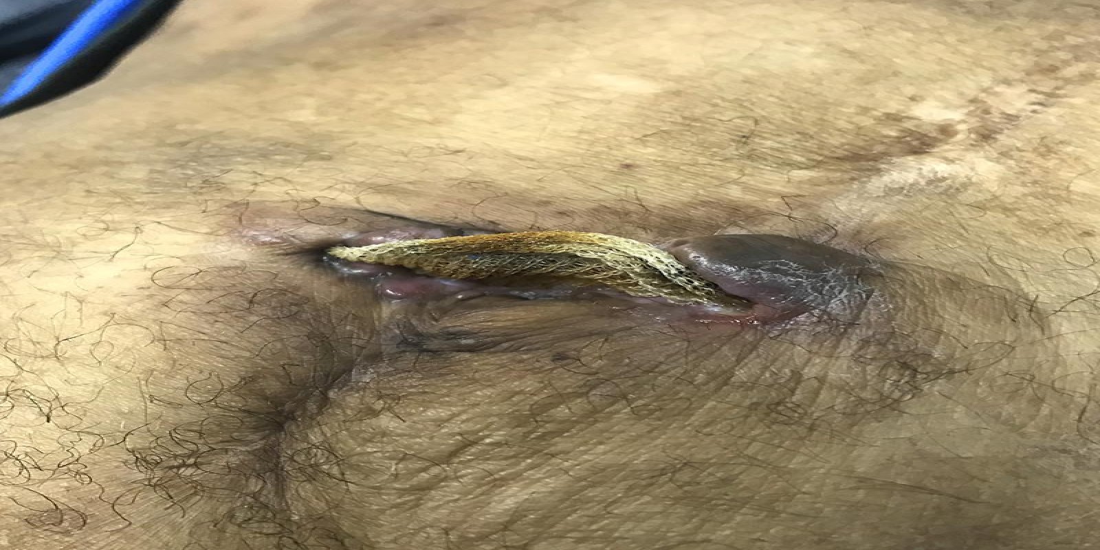 Caso Código 219A de Hérnia Incisional 219A