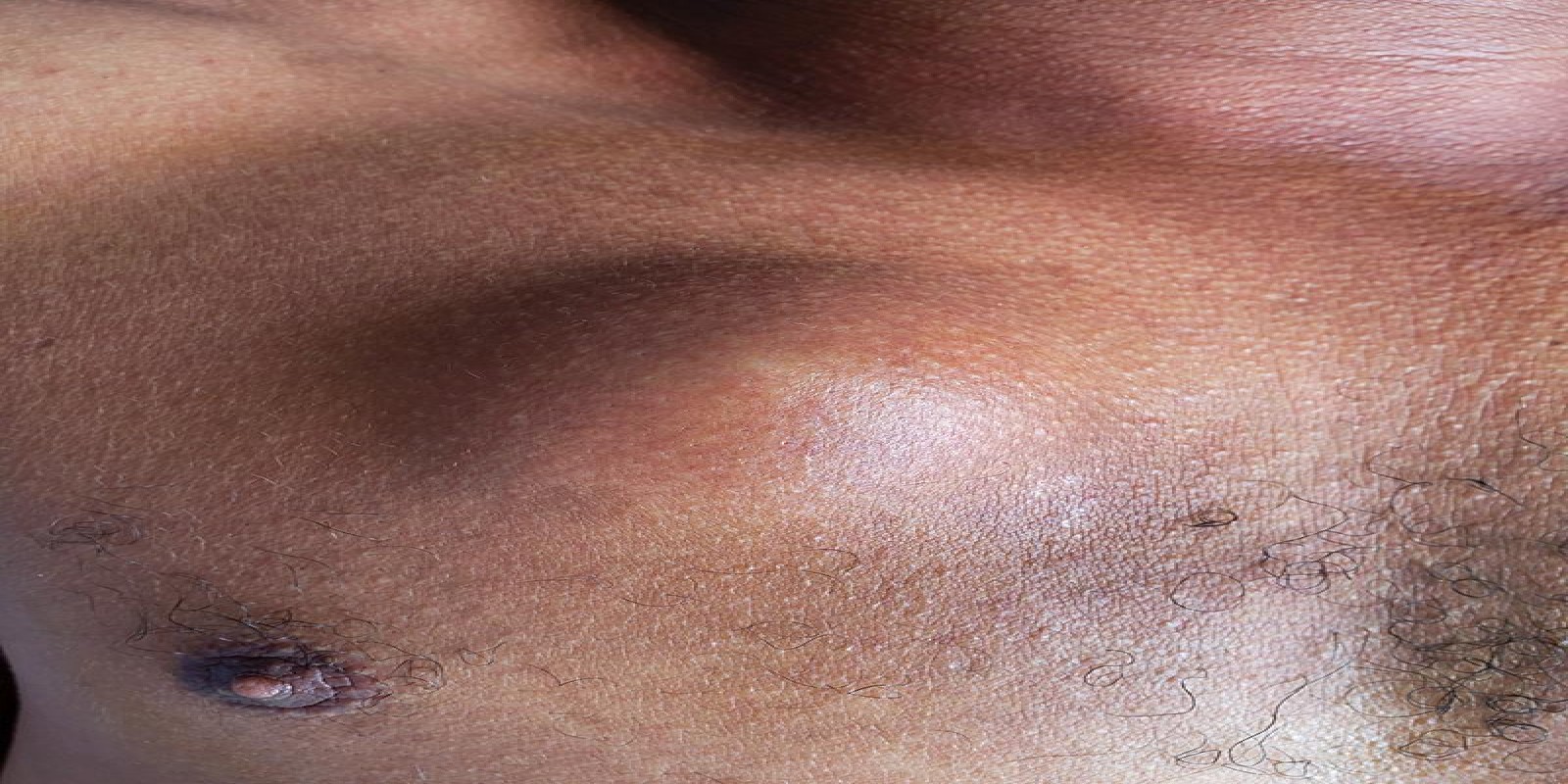 Caso Código 228A de Cisto Epidérmico 228A