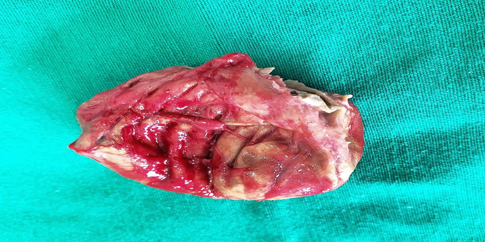 Caso Código 228B de Cisto Epidérmico 228B