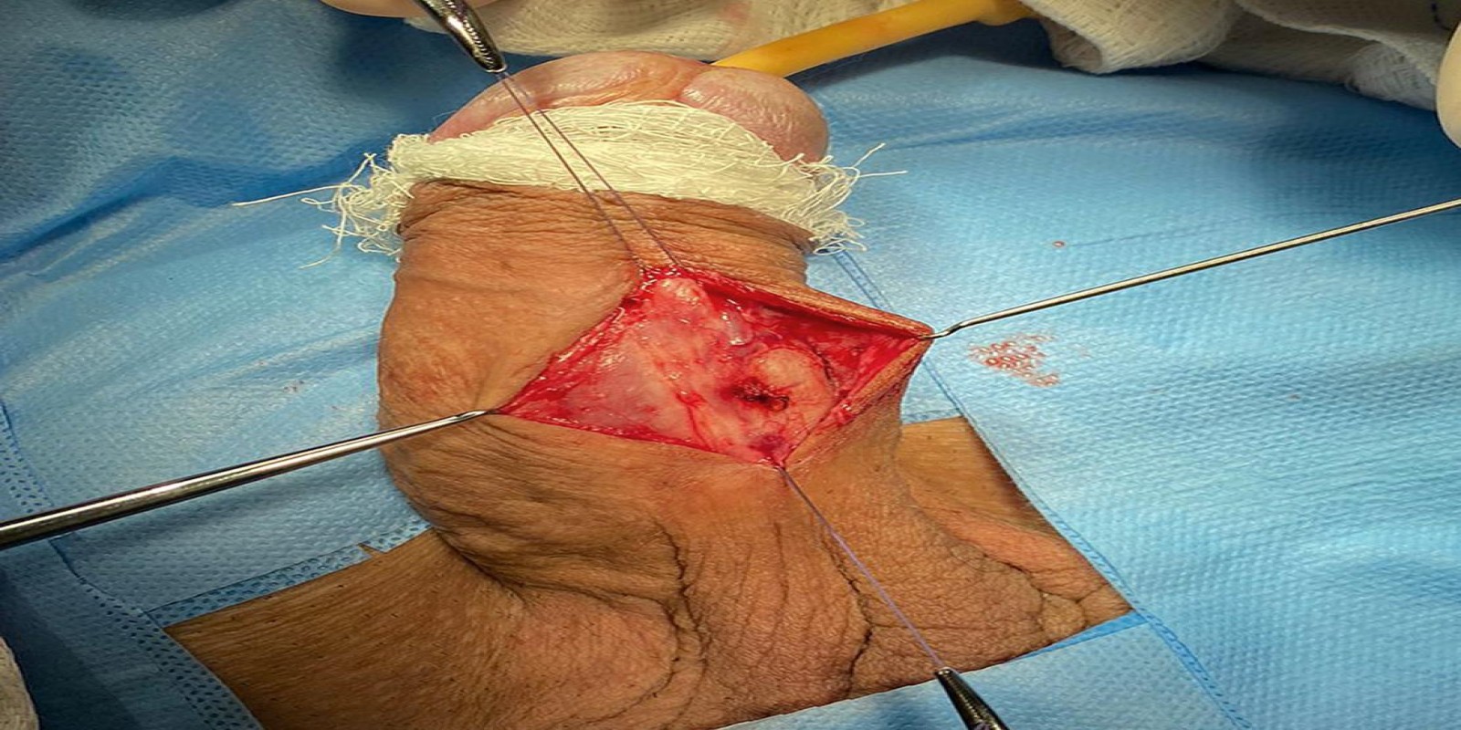 Caso Código 233A de Disfunção erétil 233A