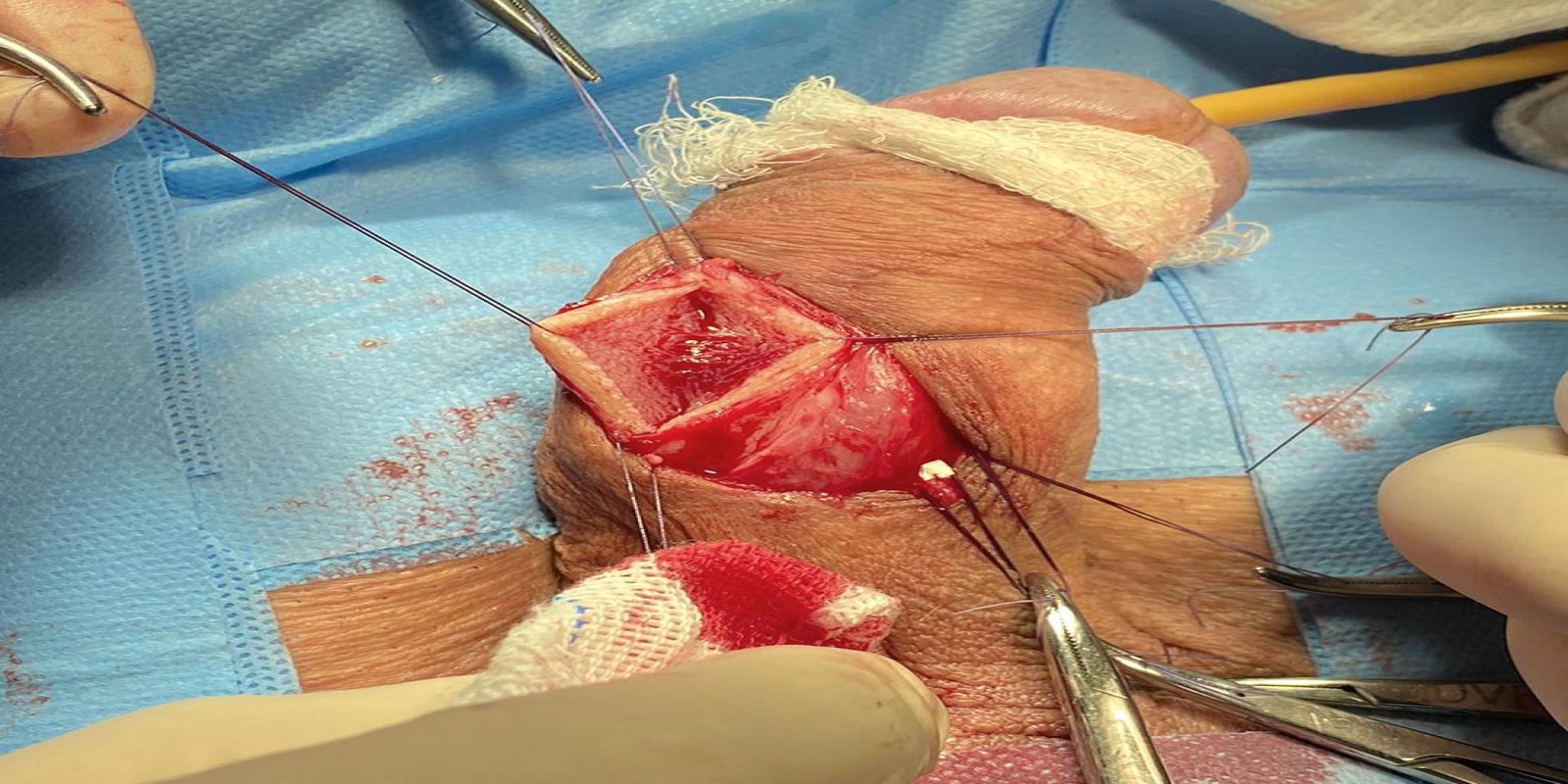 Caso Código 233B de Disfunção erétil 233B