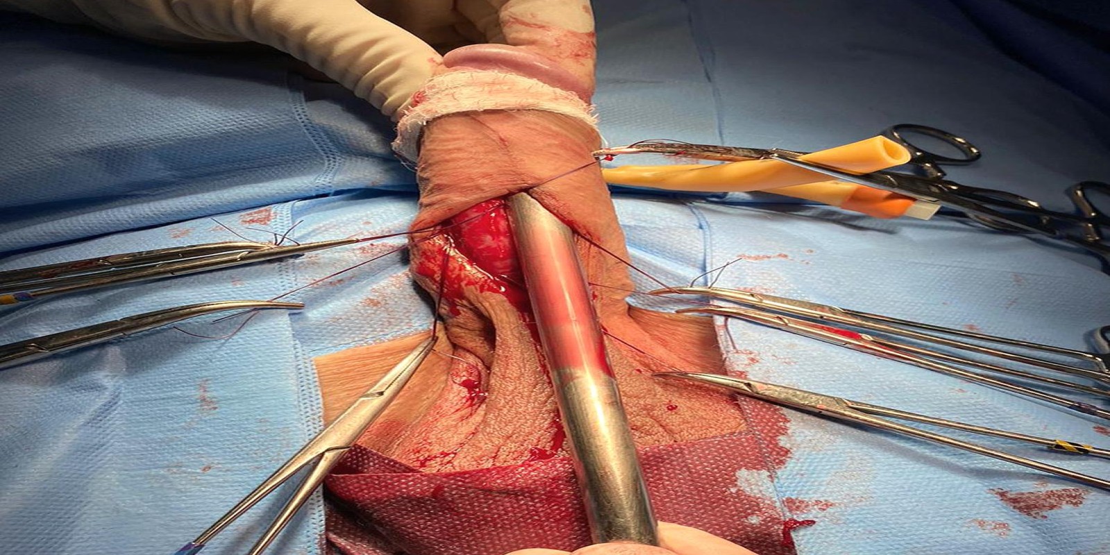 Caso Código 233C de Disfunção erétil 233C