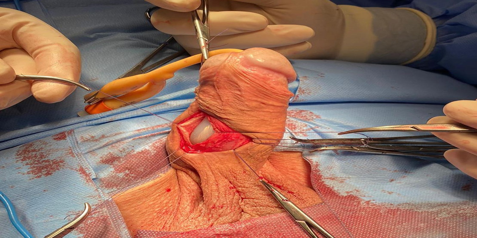 Caso Código 233D de Disfunção erétil 233D