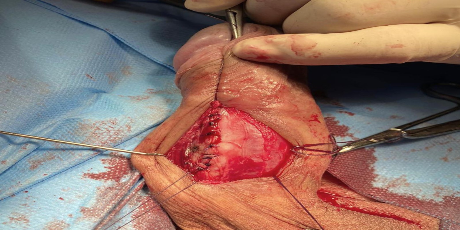 Caso Código 233E de Disfunção erétil 233E