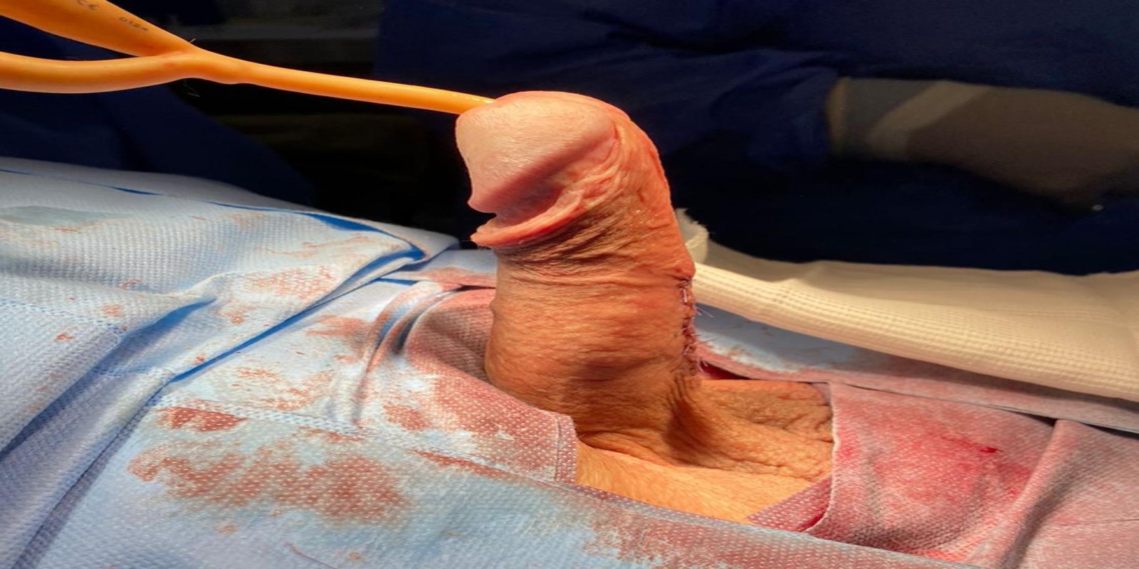 Caso Código 233F de Disfunção erétil 233F