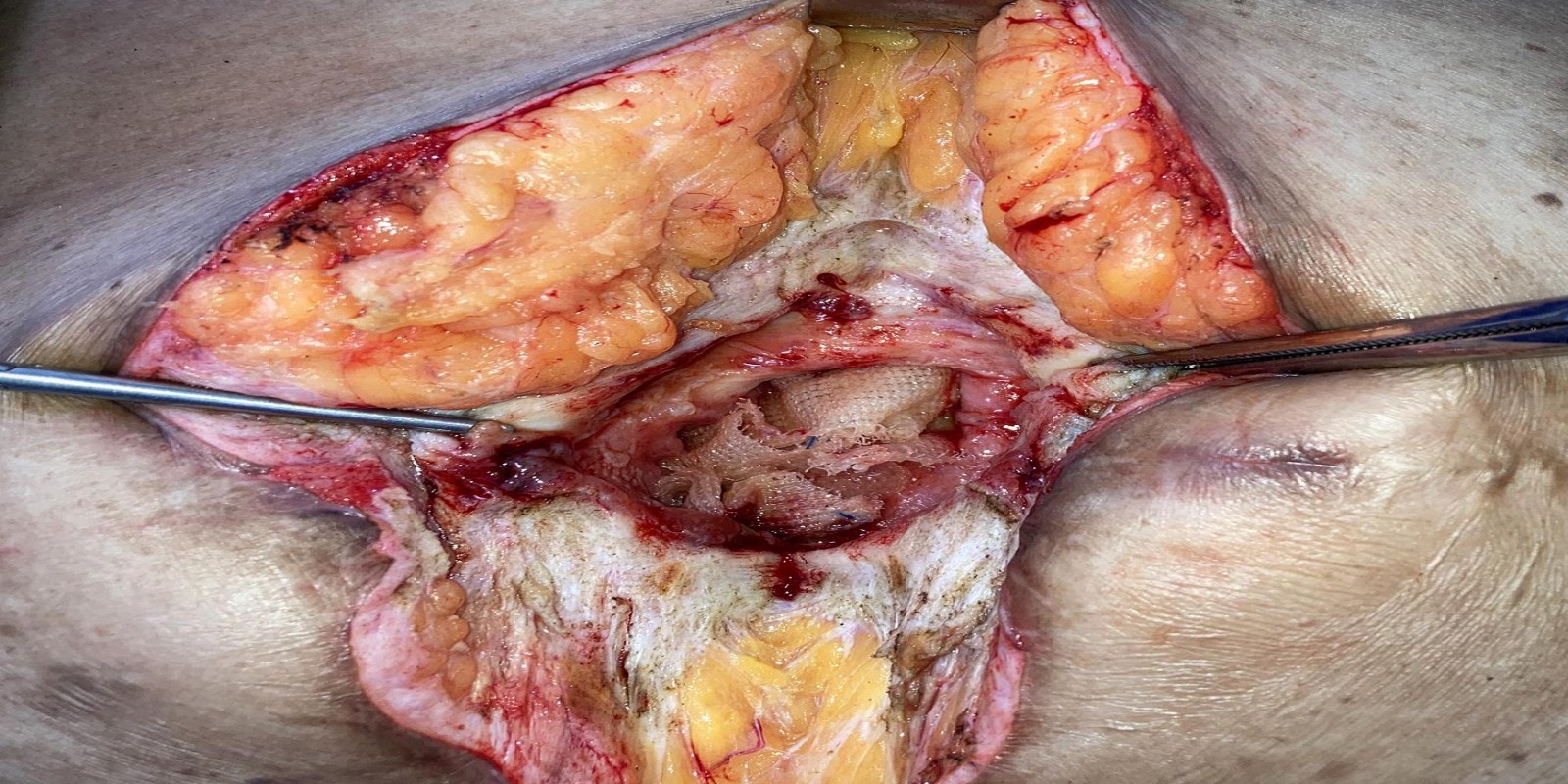 Caso Código 235A de Hérnia Incisional 235A