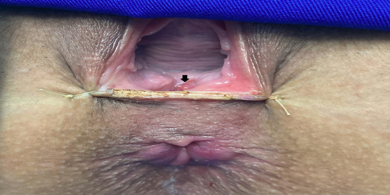 Caso Código 238B de Fístula reto-vaginal 238B