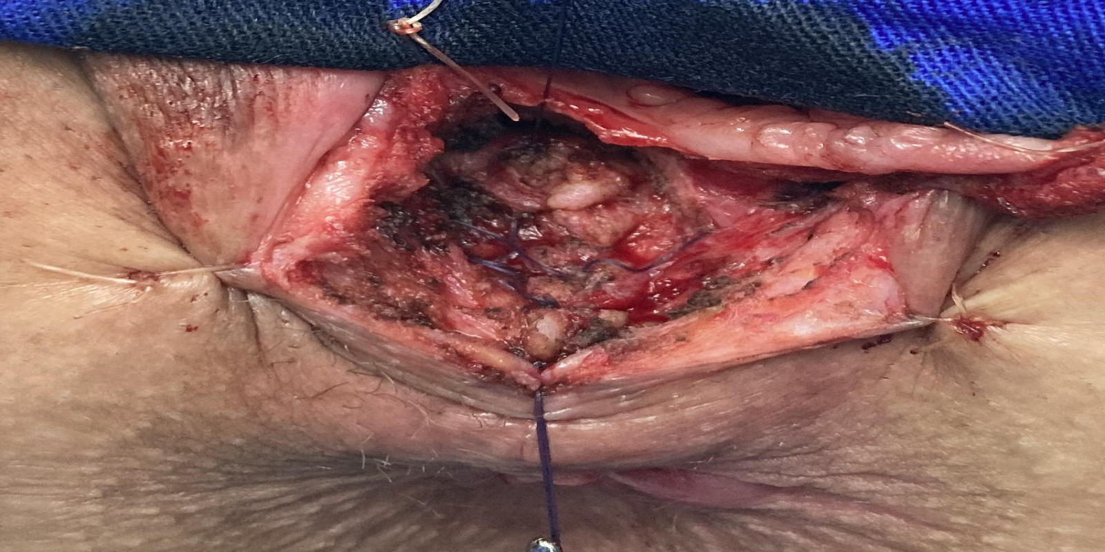 Caso Código 238C de Fístula reto-vaginal 238C