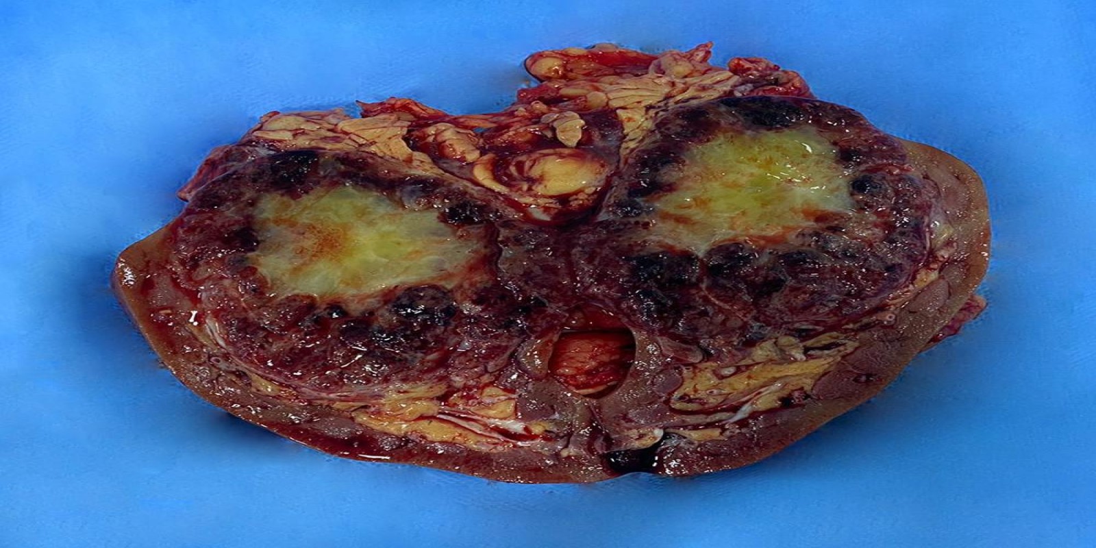 Caso Código 242A de Tumor de células claras 242A