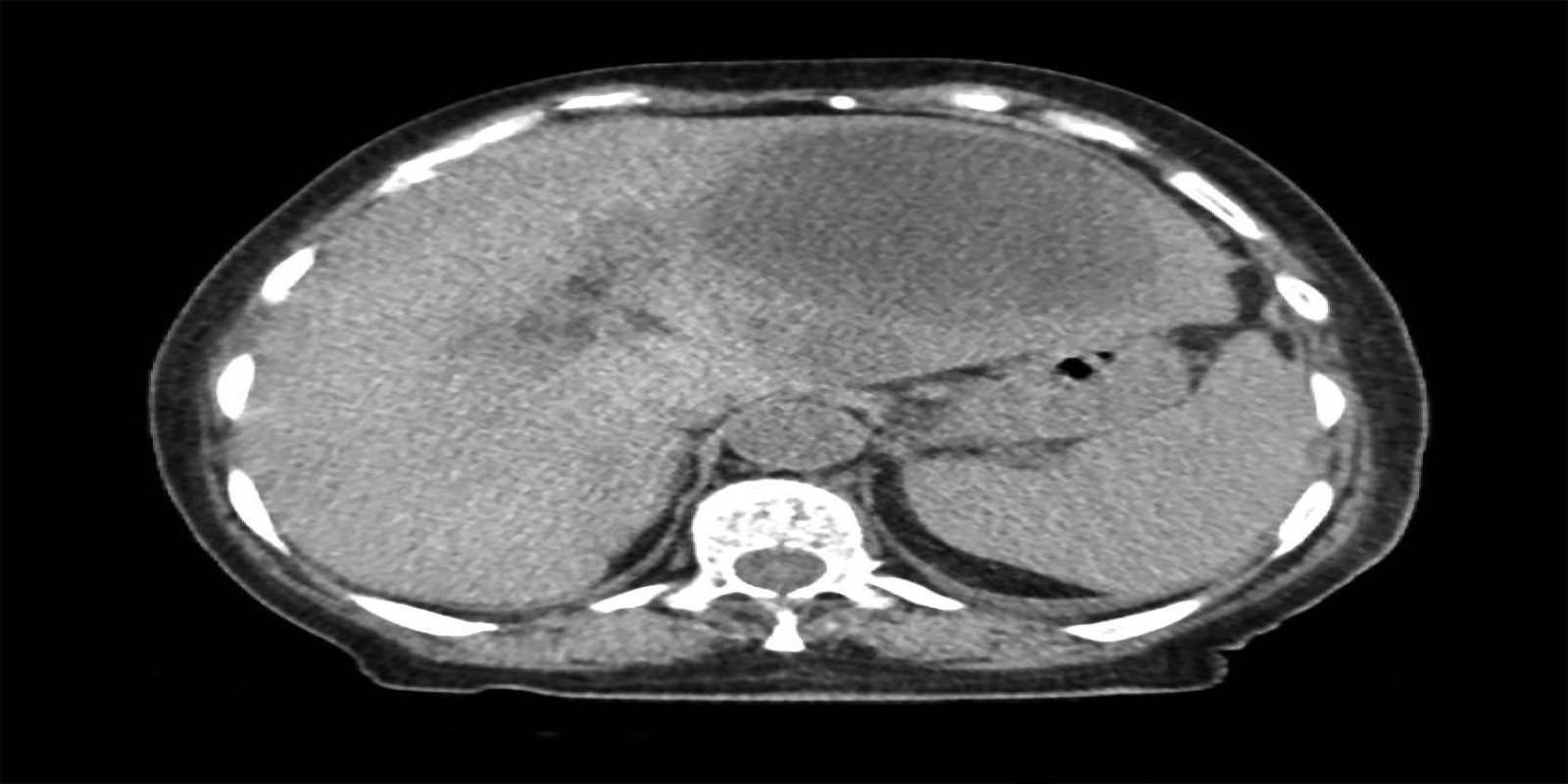 Caso Código 247A de Abscesso Hepático 247A