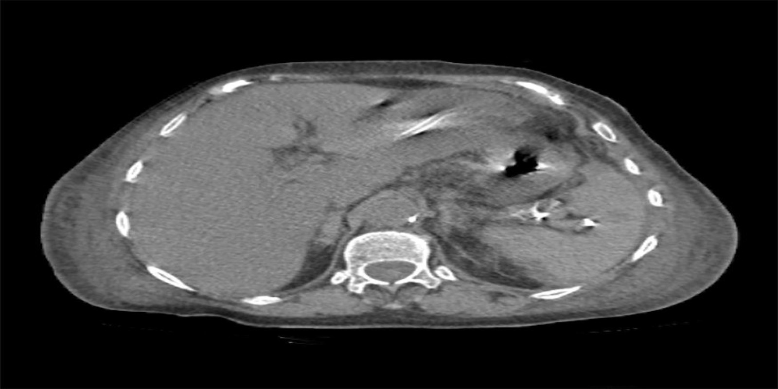 Caso Código 247B de Abscesso Hepático 247B
