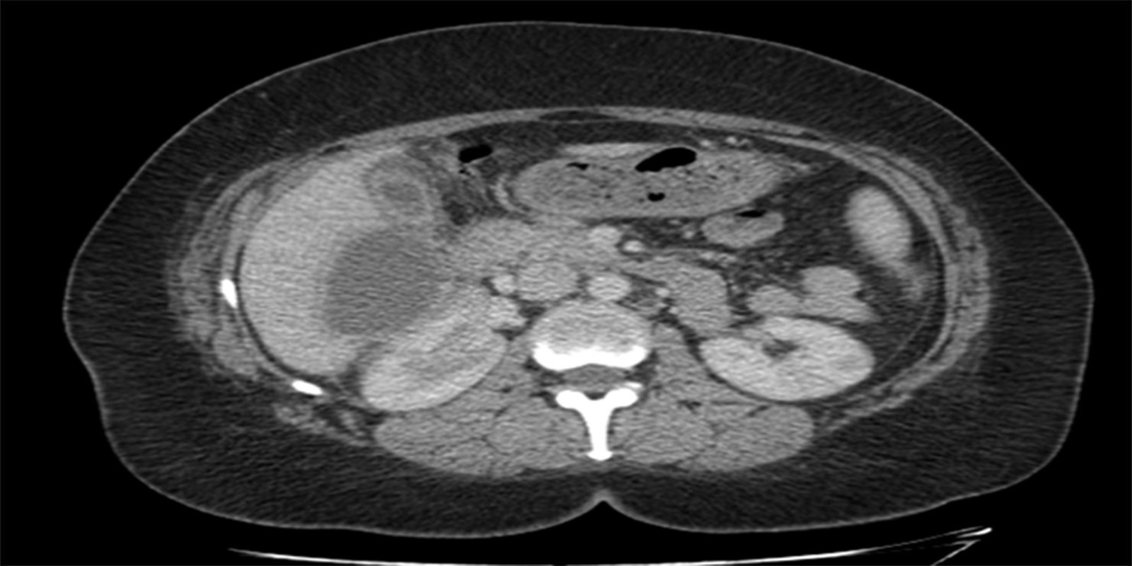 Caso Código 251A de Colecistite Aguda 251A