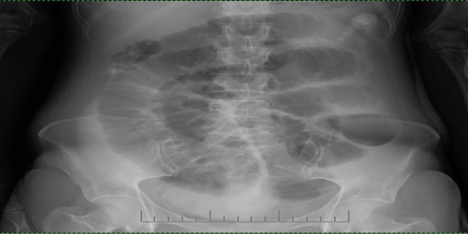 Caso Código 253A de Obstrução Intestinal do Delgado 253A