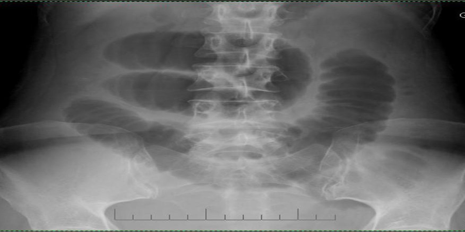 Caso Código 253B de Obstrução Intestinal do Delgado 253B