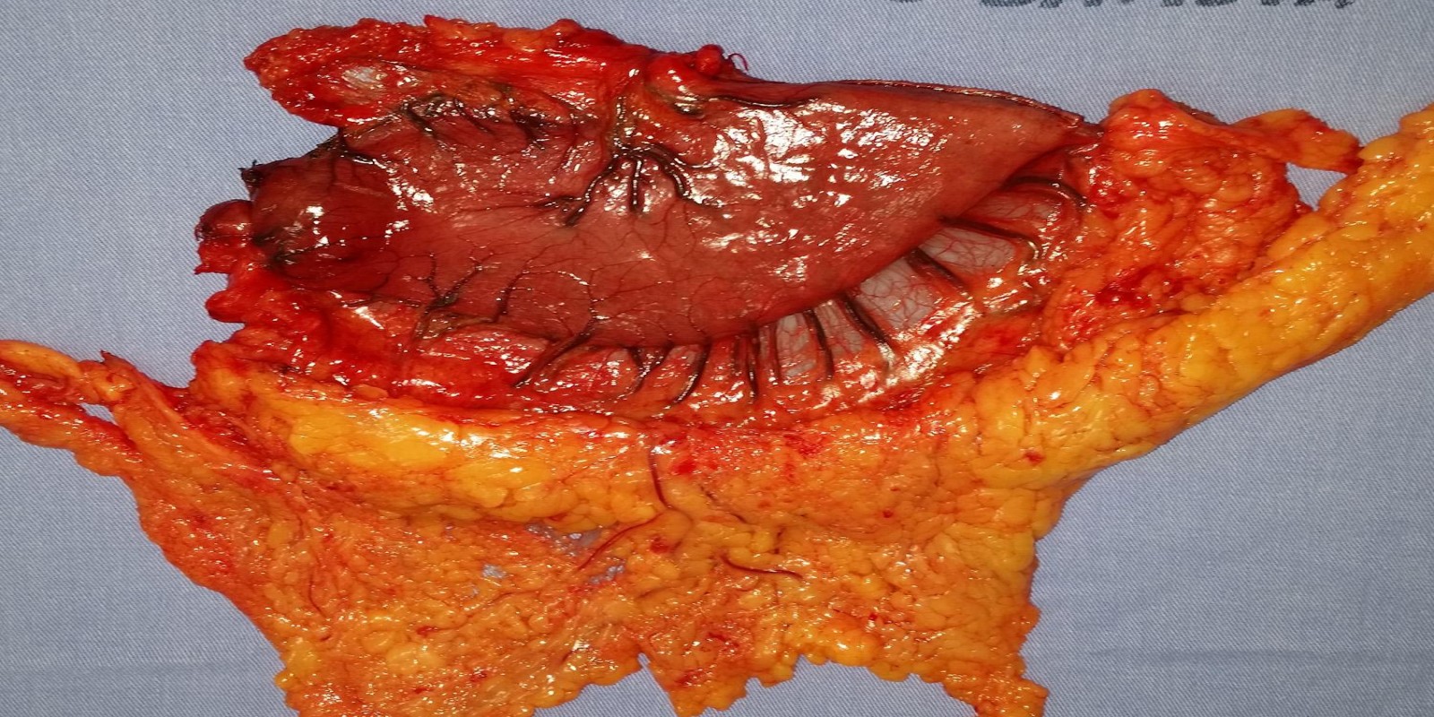Caso Código 254A de Câncer Gástrico 254A