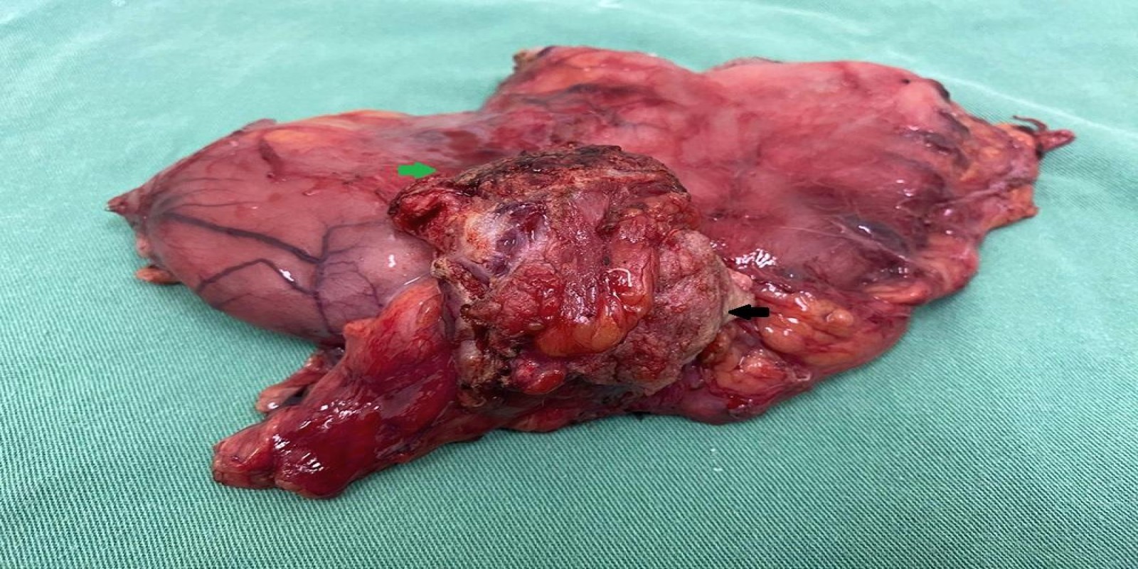 Caso Código 259A de Câncer Gástrico 259A