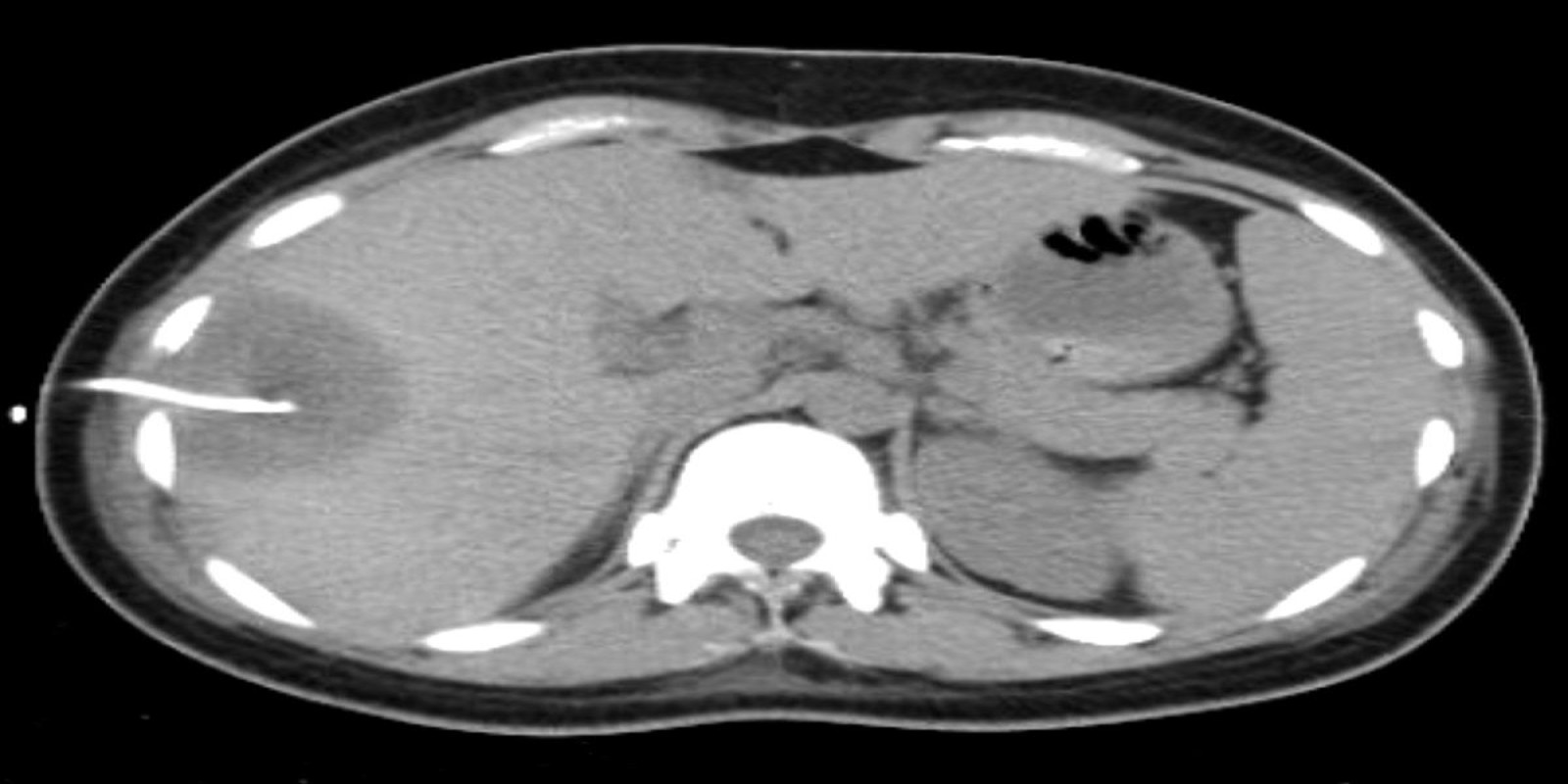 Caso Código 261B de Abscesso Hepático 261B