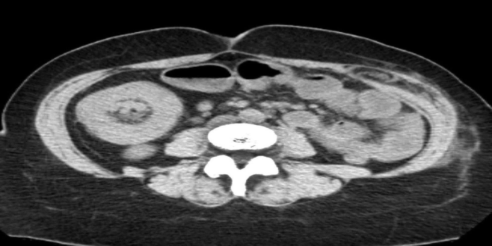Caso Código 267A de Intussuscepção 267A