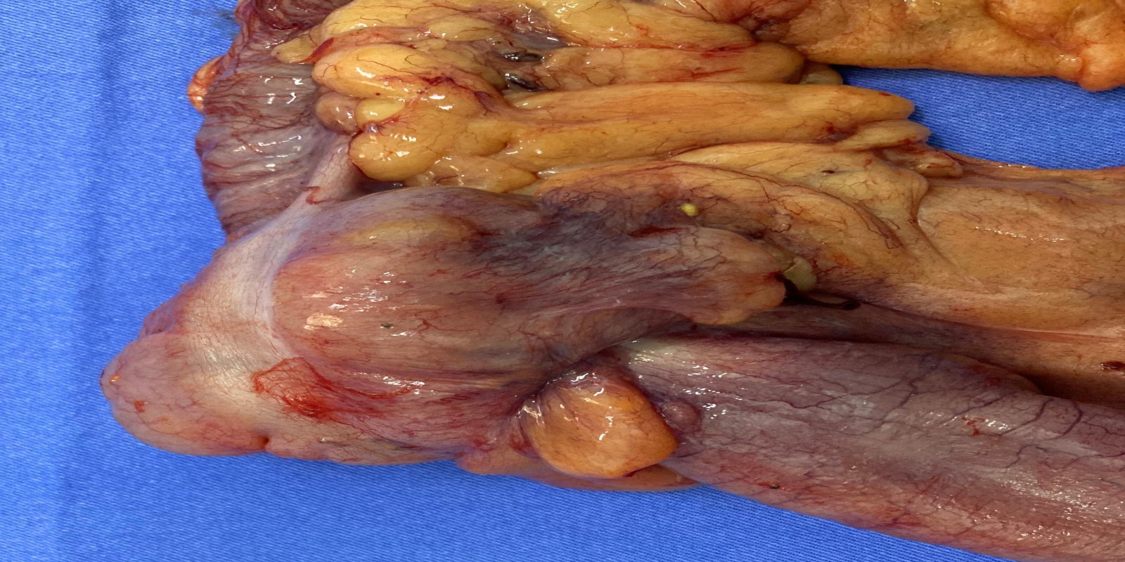 Caso Código 267C de Intussuscepção 267C