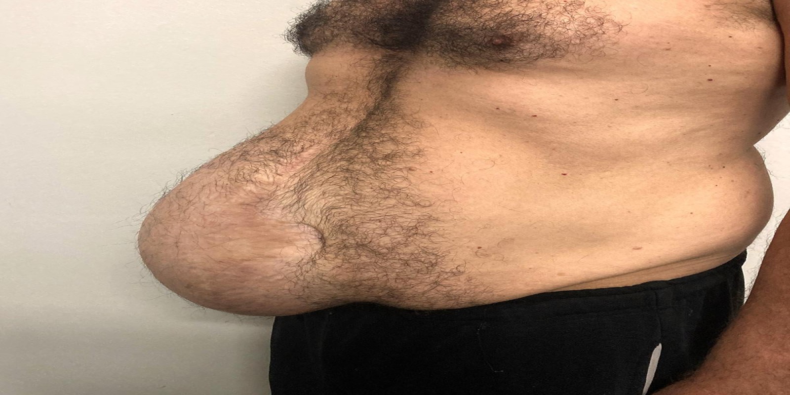 Caso Código 270B de Hérnia Incisional 270B