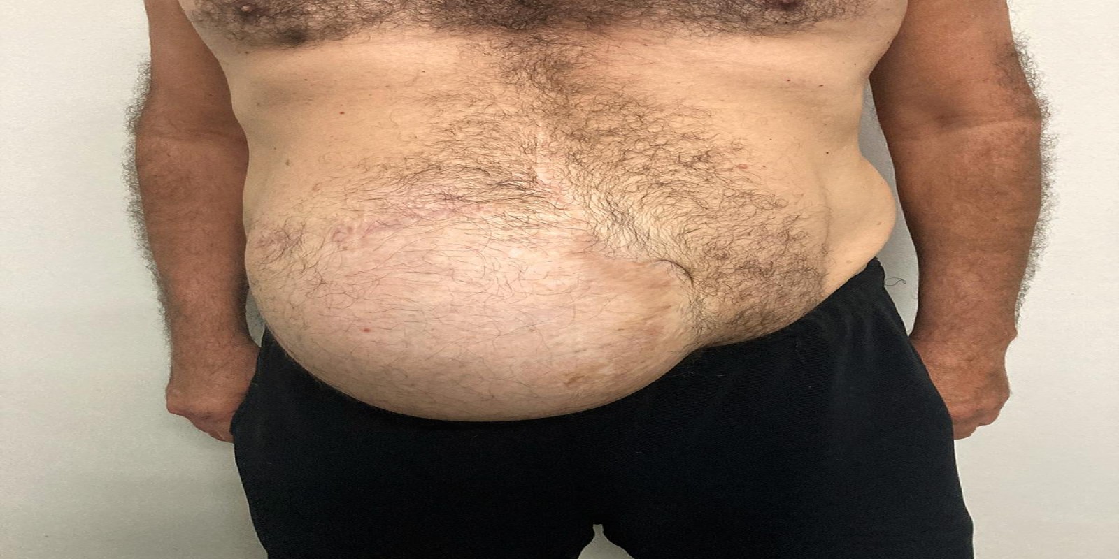 Caso Código 270A de Hérnia Incisional 270A