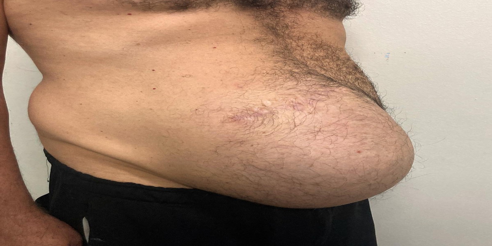 Caso Código 270C de Hérnia Incisional 270C