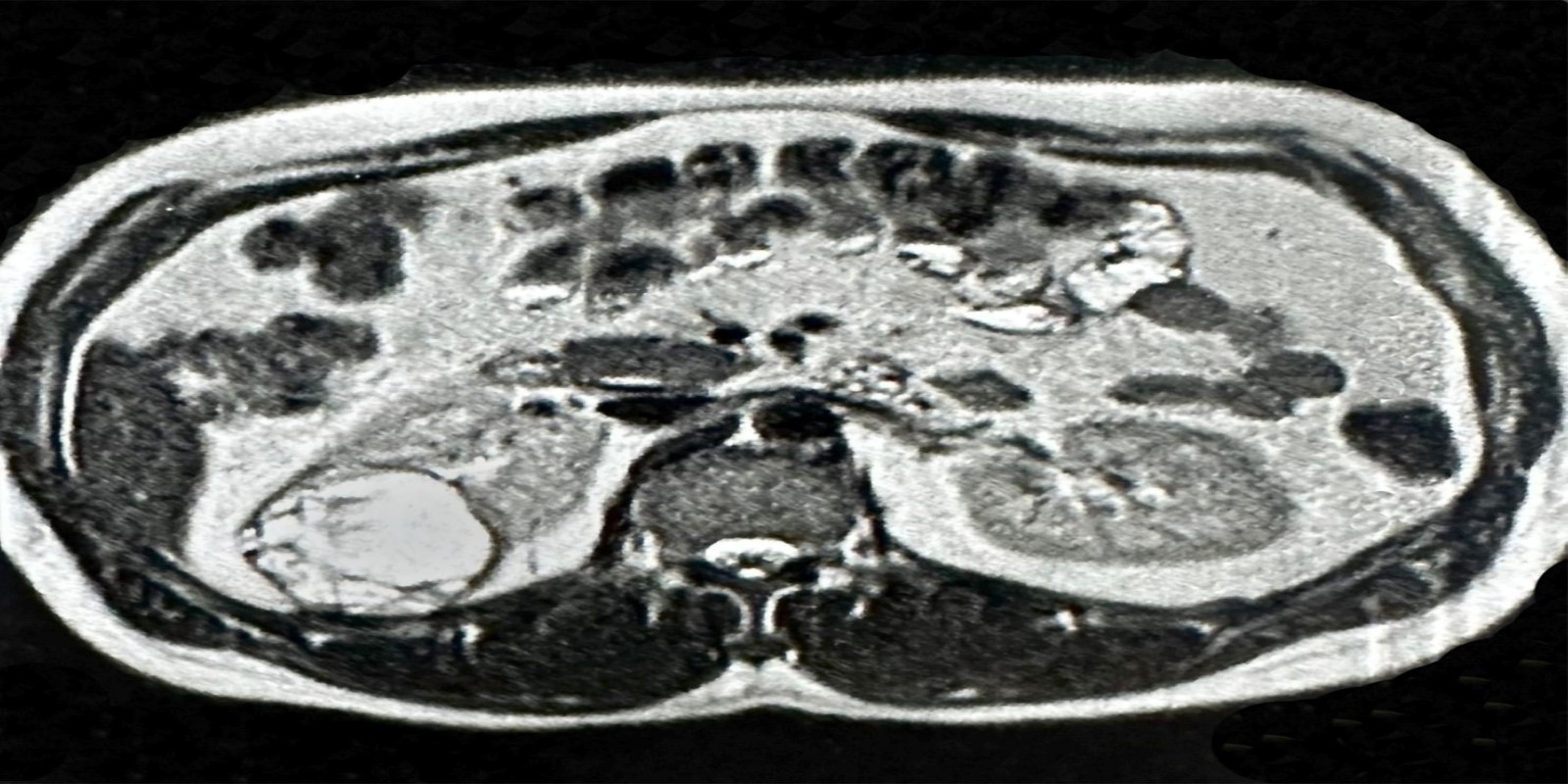 Caso Código 271A de Tumor de células claras 271A