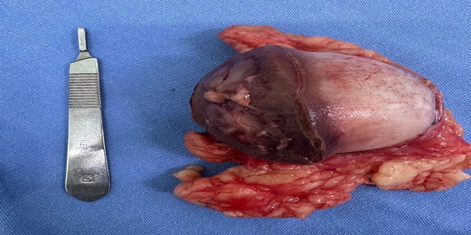 Caso Código 271B de Tumor de células claras 271B