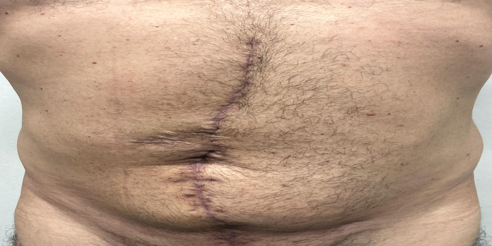 Caso Código 270D de Hérnia Incisional 270D