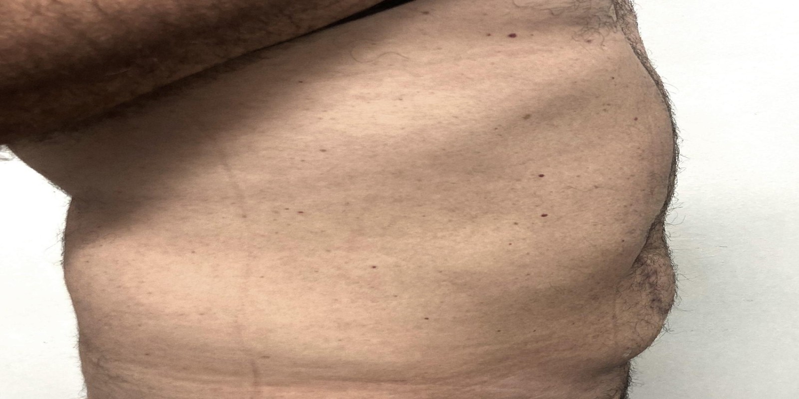 Caso Código 270E de Hérnia Incisional 270E